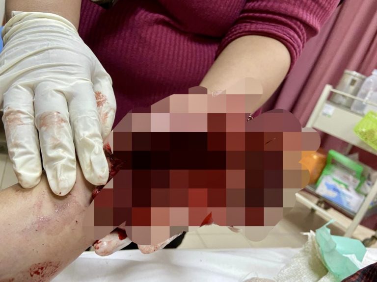 Lelaki cedera parah tertembak diri sendiri keluar memburu